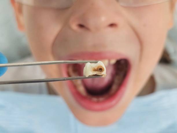 Best Broken or Chipped Tooth Repair in Sto Brook, NY